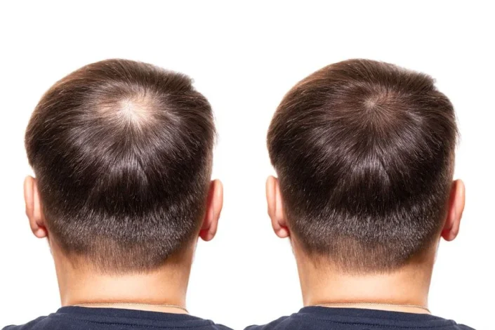 Behandeling van haarverlies by mans met minoxidil