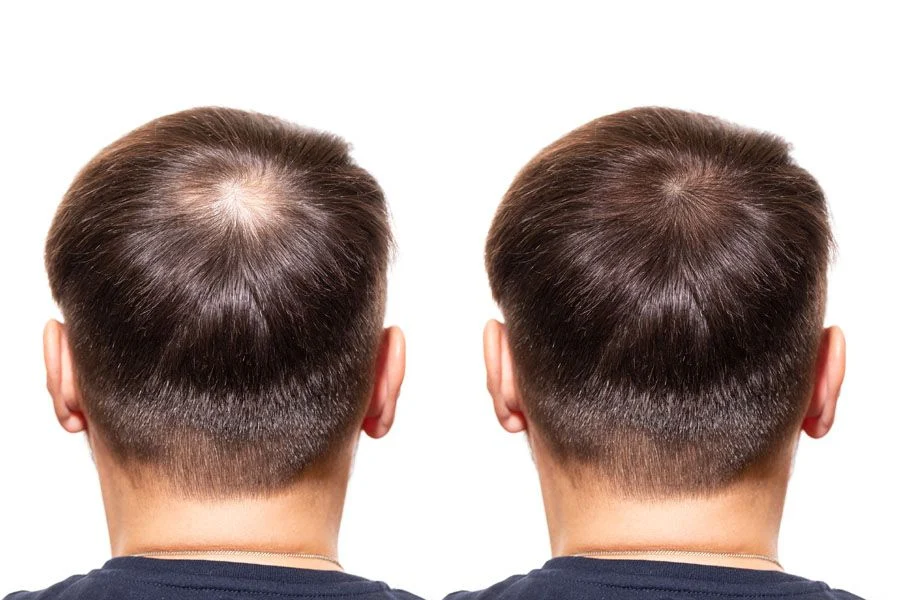 Behandeling van haarverlies by mans met minoxidil