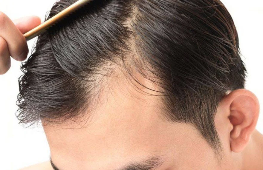 Advantages, side effects and how to use minoxidil for hair