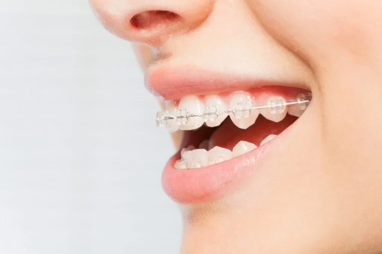 بعد از ارتودنسی چه باید کرد؟