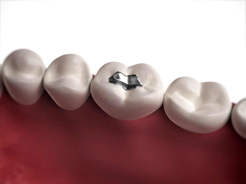 آیا آمالگام دندانپزشکی برای سلامتی خطر دارد؟ + حفظ سلامت دندان