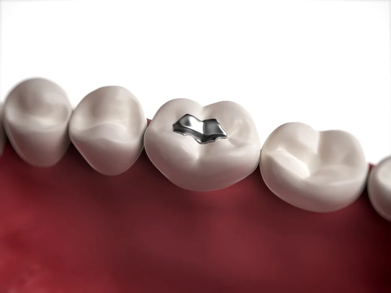 آیا آمالگام دندانپزشکی برای سلامتی خطر دارد؟ + حفظ سلامت دندان