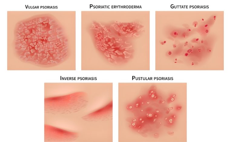 افزایش جهانی ابتلا به پسوریازیس و ضرورت توجه به سلامت پوست